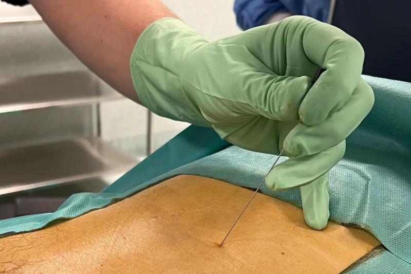 Plasma-rico-en-plaquetas-intradiscal-Instituto-Cugat-1